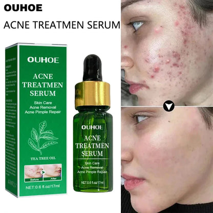 Acne Treatment Facial Serum Pore Shrinking Skin Care - BeautiMass