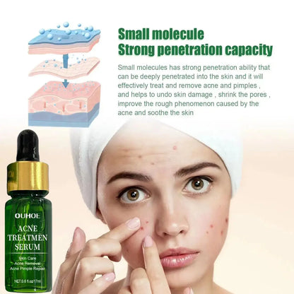 Acne Treatment Facial Serum Pore Shrinking Skin Care - BeautiMass