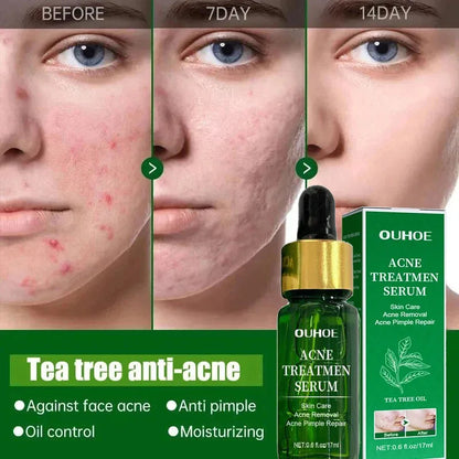 Acne Treatment Facial Serum Pore Shrinking Skin Care - BeautiMass